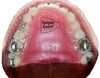 RPE Tongue Guard: Prevents and Helps Heal Tongue Sores Caused by Dental Expanders