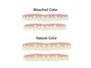 Imako Cosmetic Teeth - 1 Pack - Large, Bleached - Upper Veneers - Custom Fit at Home, Arrives Flat, DIY Smile Makeover, Made in USA!